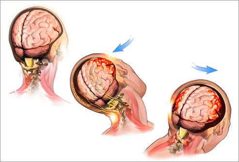 head injury - alternative concussion treatment