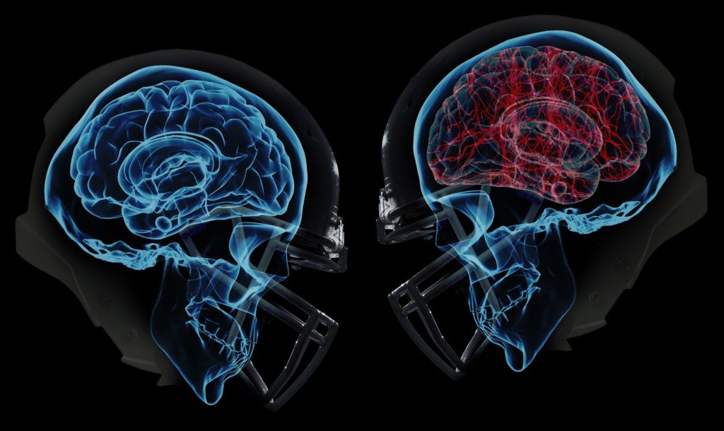 alternative concussion treatment - two helmets colliding